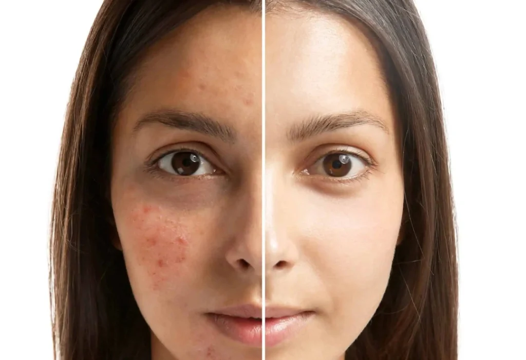 Acne Removal Toronto